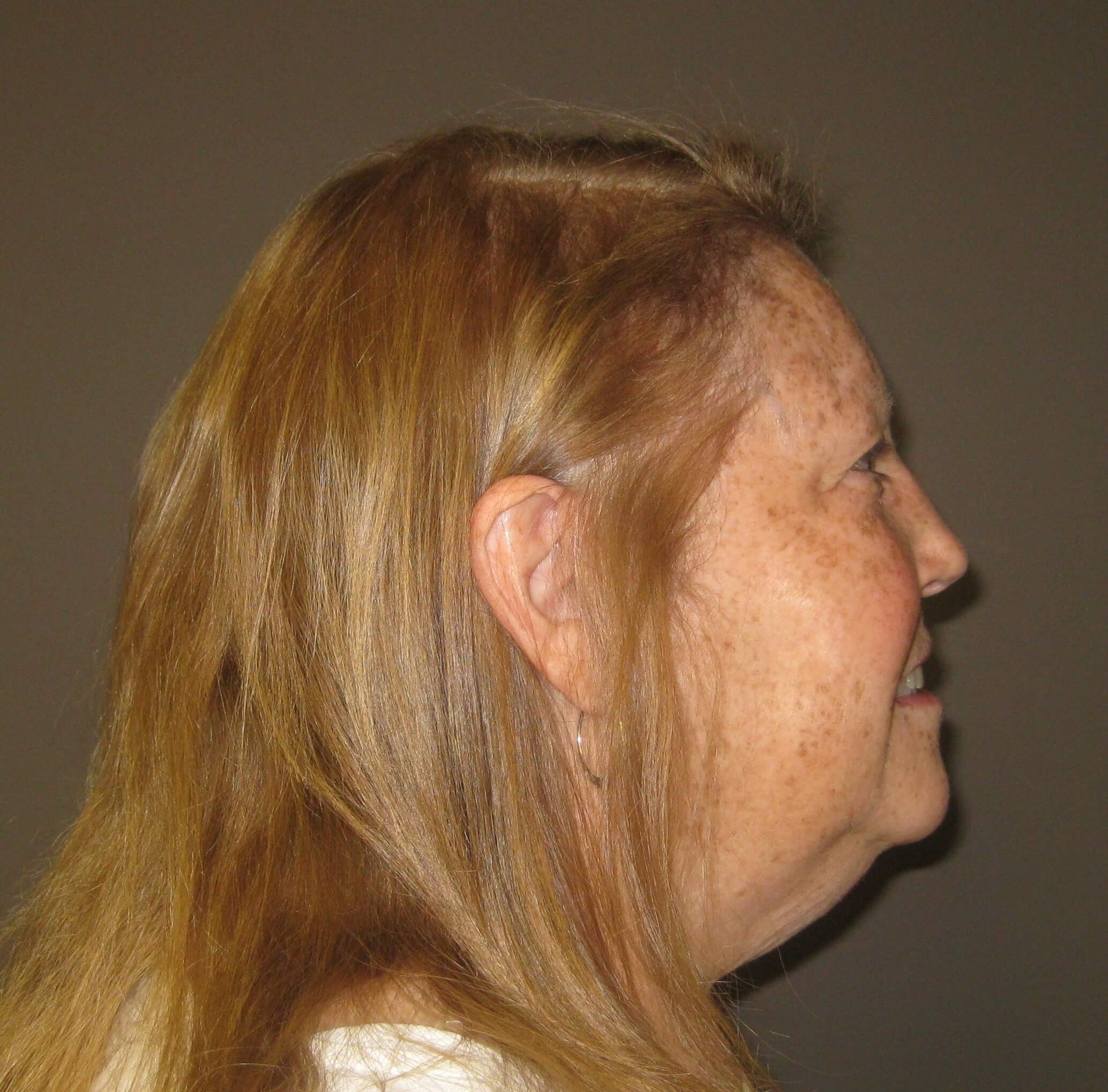 Side Before