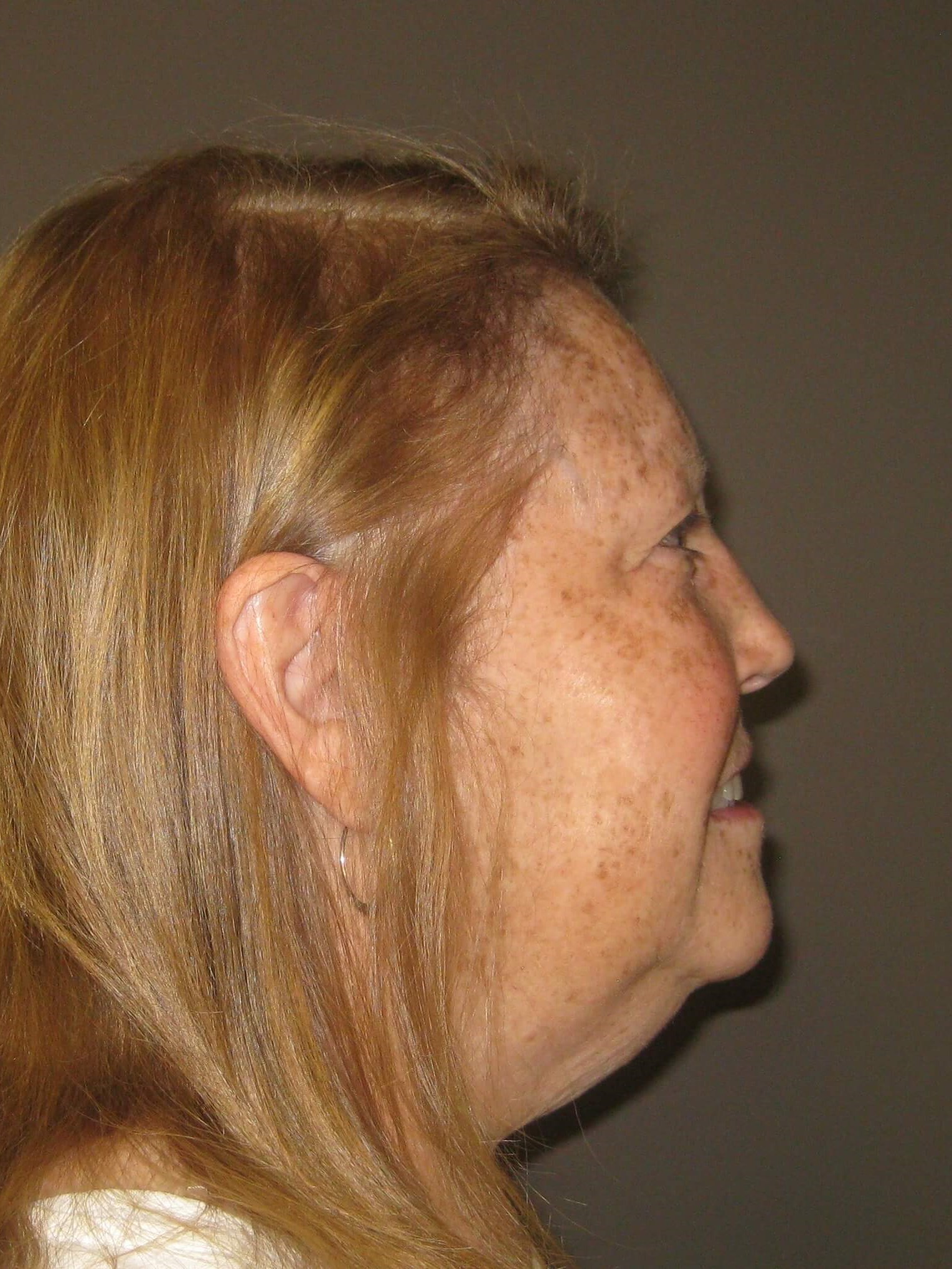 Side Before