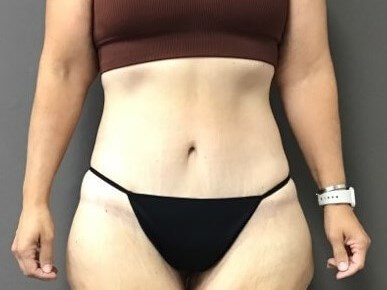 Anterior After