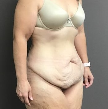Oblique Before
