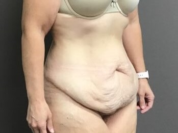 Oblique Before
