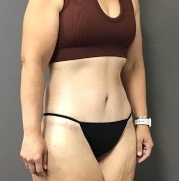 Oblique After