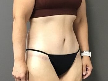 Oblique After
