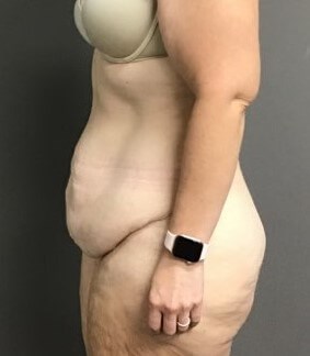 Side Before