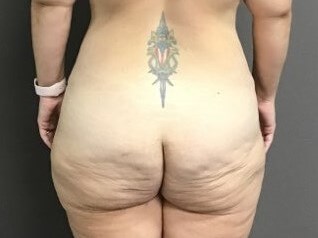 Posterior Before