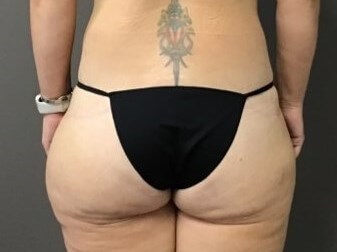 Posterior After