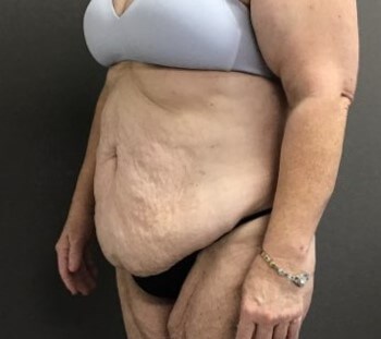 Oblique Before
