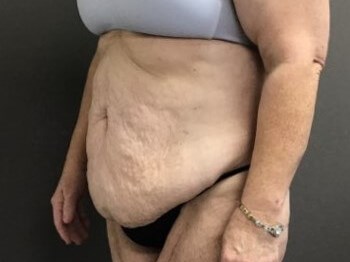 Oblique Before