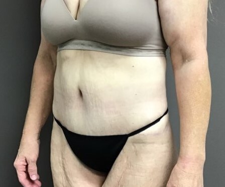 Oblique After