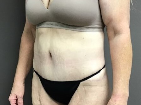 Oblique After