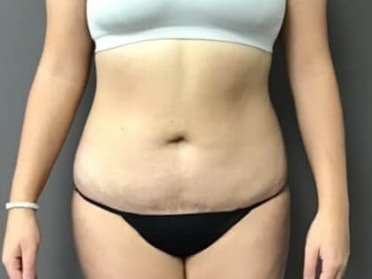 Anterior After