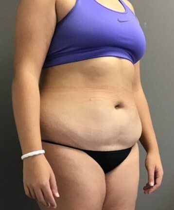 Oblique Before