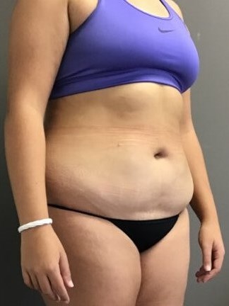 Oblique Before