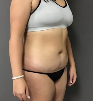 Oblique After