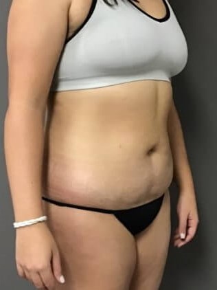 Oblique After