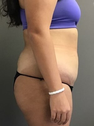 Side Before