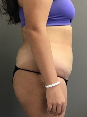 Side Before