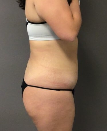 Side After