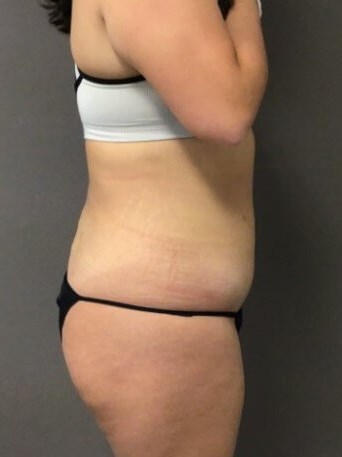 Side After