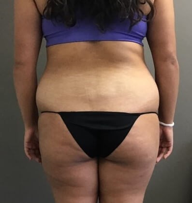 Posterior Before