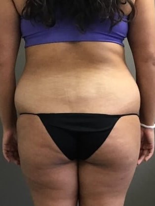 Posterior Before
