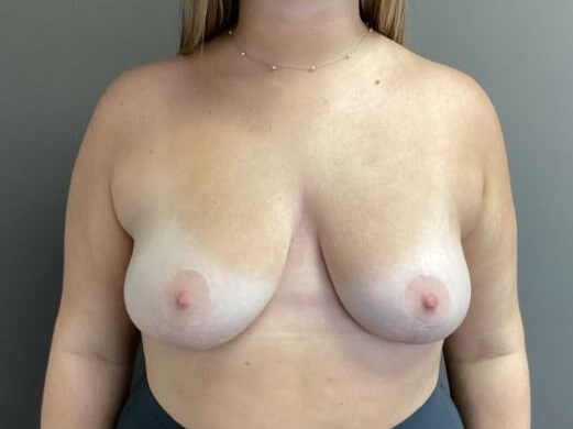 Anterior After