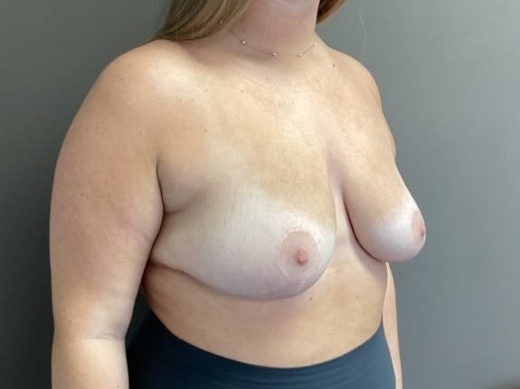 Oblique After