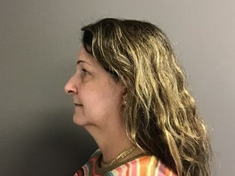 Side Before