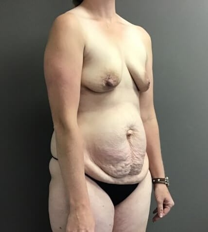 Oblique Before