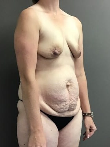 Oblique Before