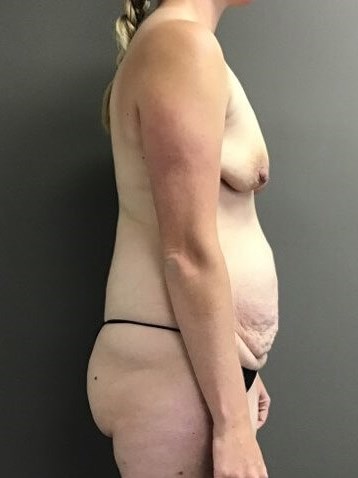 Side Before
