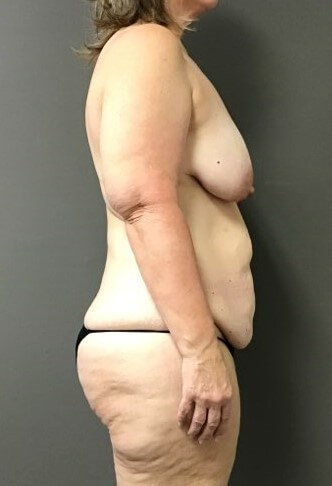 Side Before