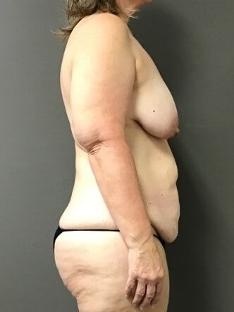 Side Before