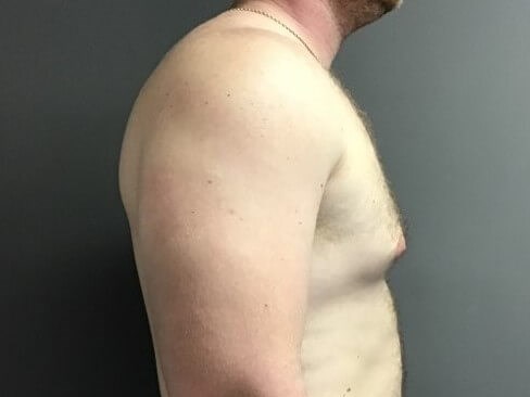 Anterior Before