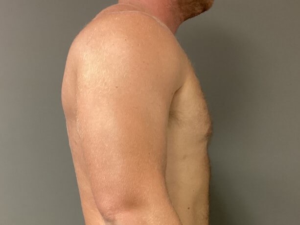 Anterior After