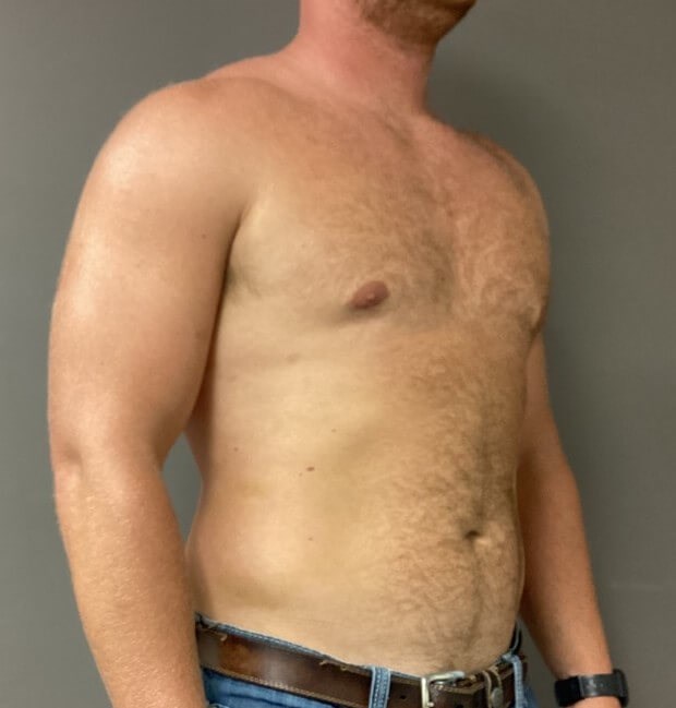 Oblique After