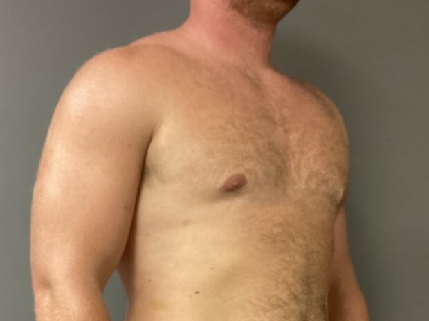 Oblique After