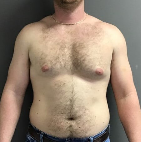 a Before