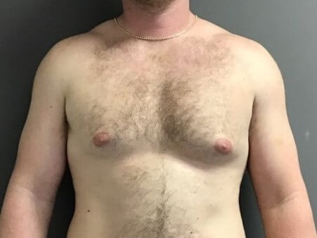 a Before