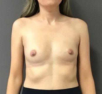 Anterior Before
