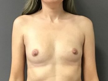 Anterior Before