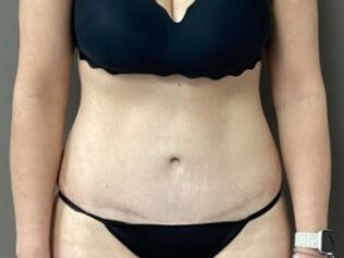 Anterior After