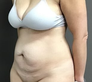 Oblique Before