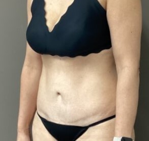 Oblique After