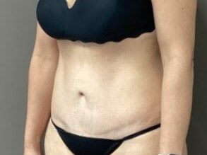 Oblique After