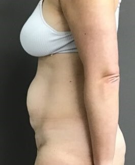 Side Before
