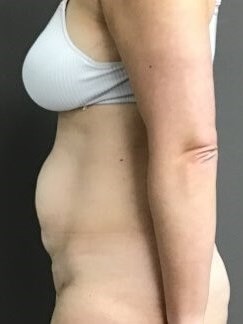 Side Before