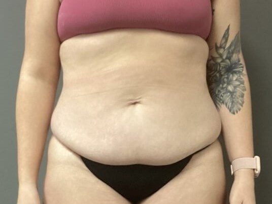 Anterior Before