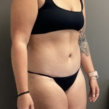 Oblique After