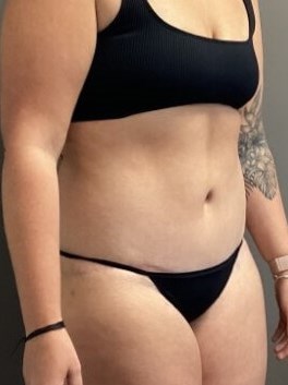 Oblique After